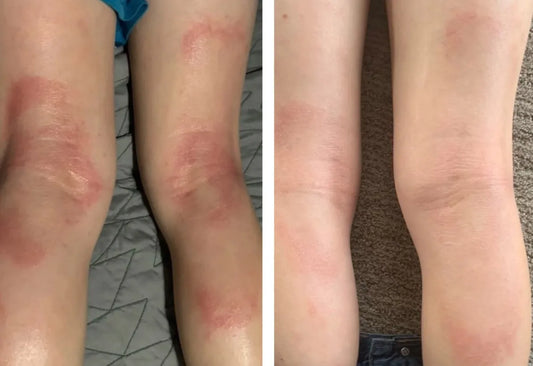Beef Tallow for Eczema and Sensitive Skin: Natural Relief That Actually Works
